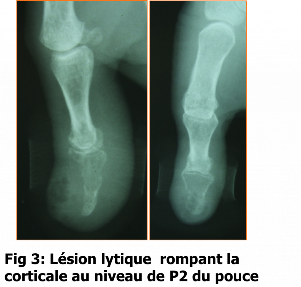 Neurofibrosarcome en dehors d’une neurofibromatose