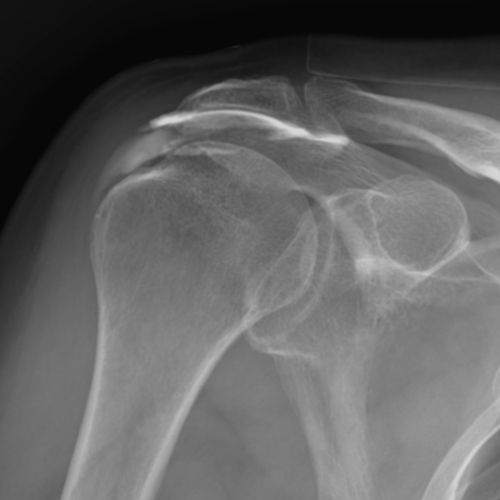 Chondromatose acromioclaviculaire