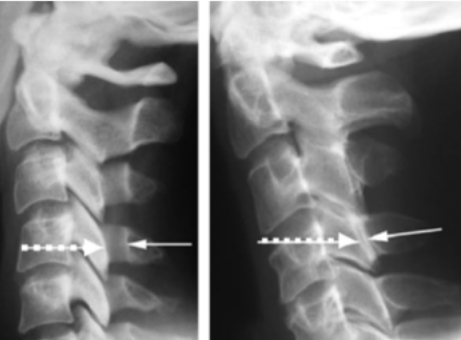 Canal cervical étroit