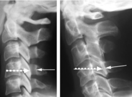 Canal cervical étroit Sotcot