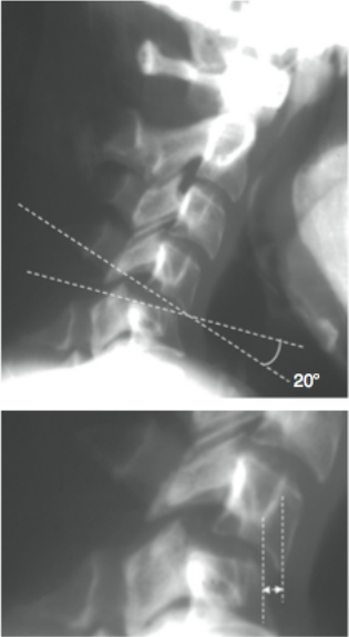 Les entorses graves du rachis cervical inférieur